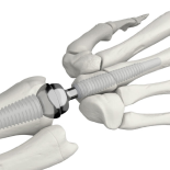 Wrist prostheses